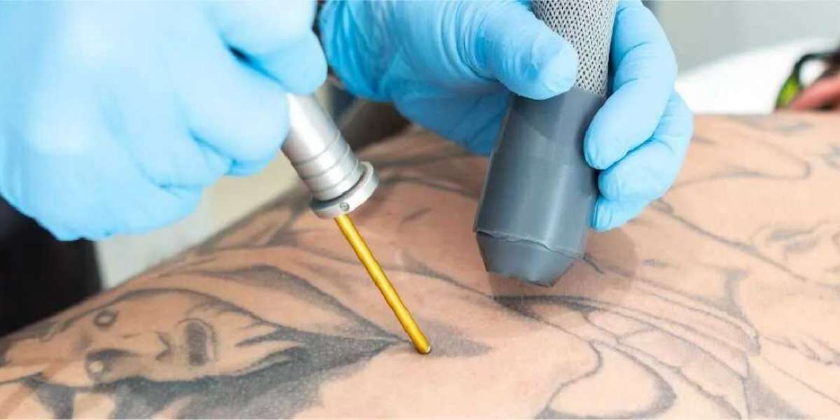 Global Tattoo Removal Market Outlook on Elevating Industry To Surpass USD 14,113.68 Million By 2030
