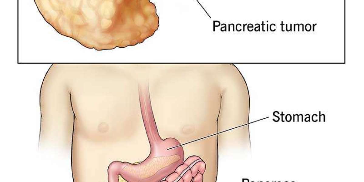 Global Pancreatic Cancer Diagnostic Market Size, Trend Report Forecast 2022 – 2032.