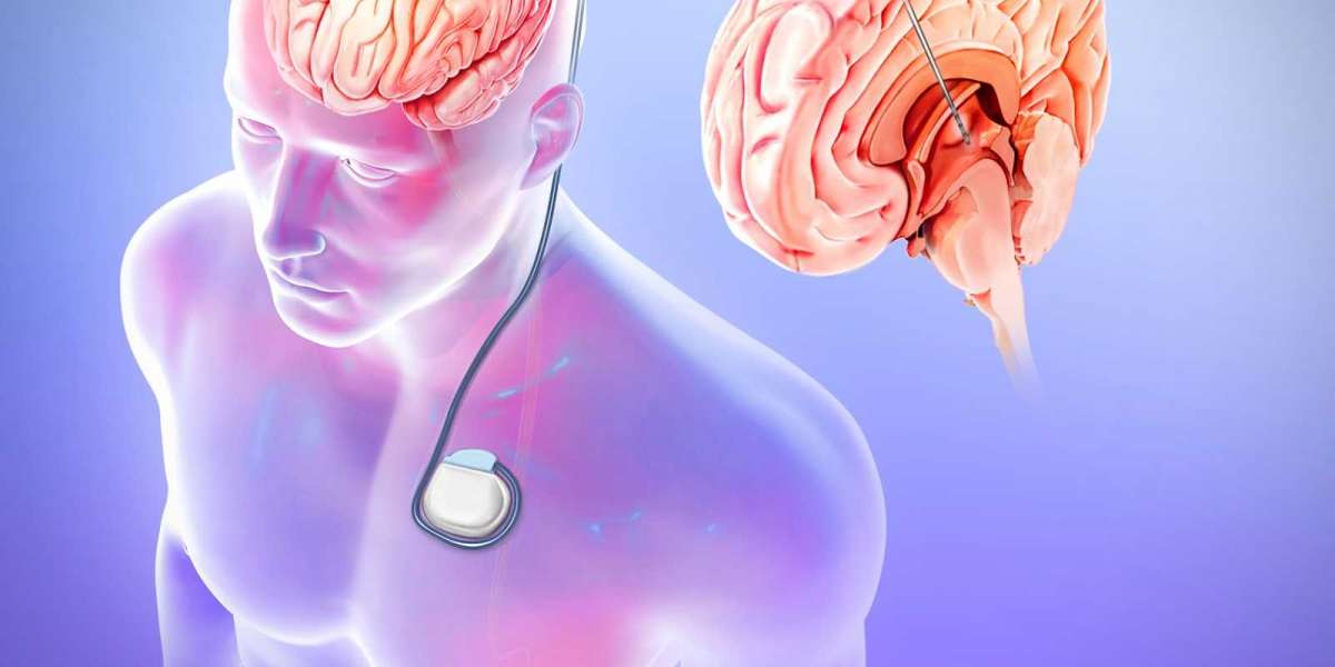 Epilepsy Surgery Market Share is Predicted to Register 5.72% CAGR between 2023-2030