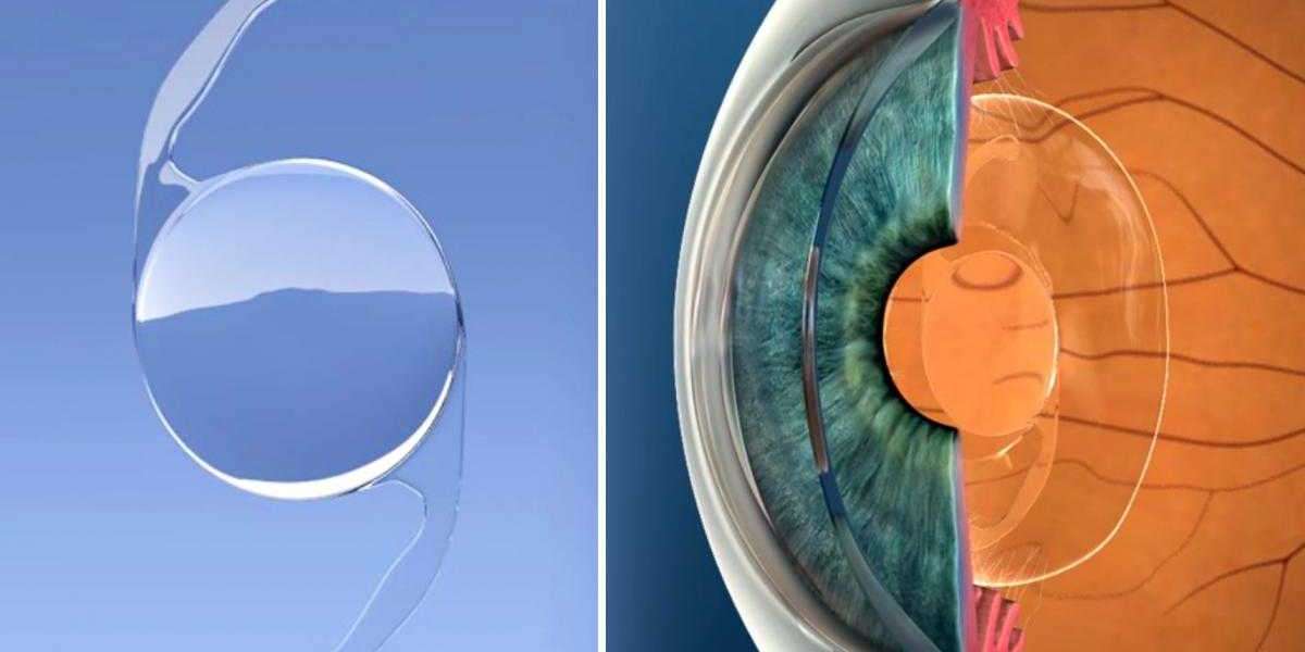 Intraocular Lens Market Outlook Study by Size and Projection