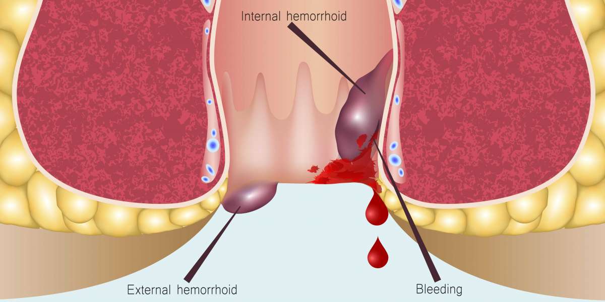 Global Hemorrhoids Treatment Market Outlook Report Projecting the Industry to Grow Exponentially by 2030