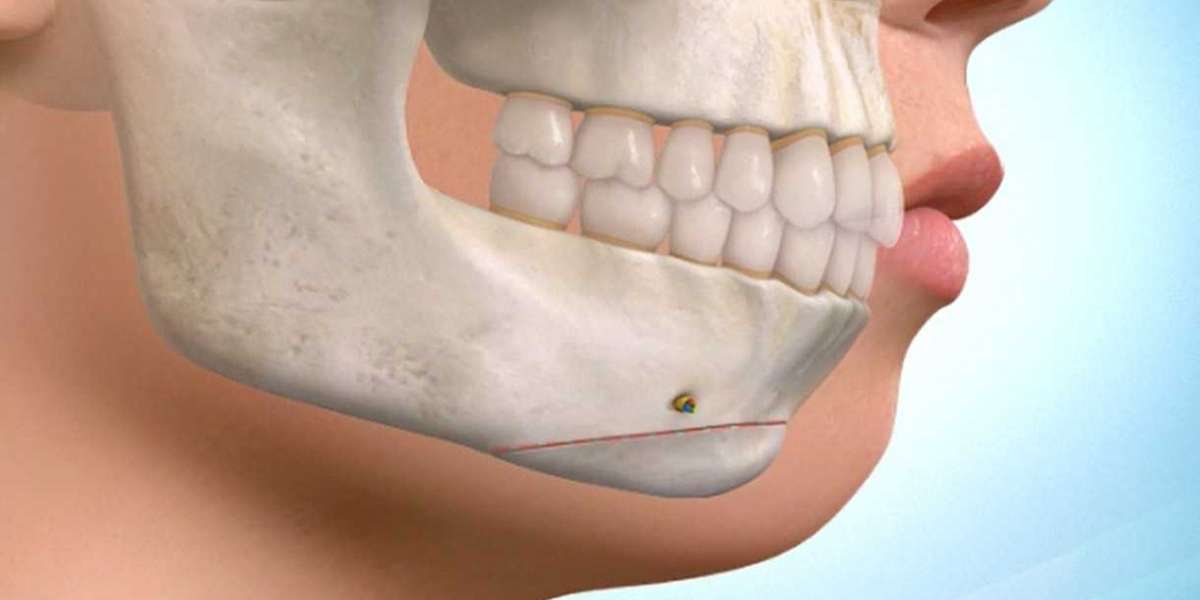 TMJ Implants Market Outlook Shows Industry Maintains Relentless Speed as Spending Money on Healthcare Increased
