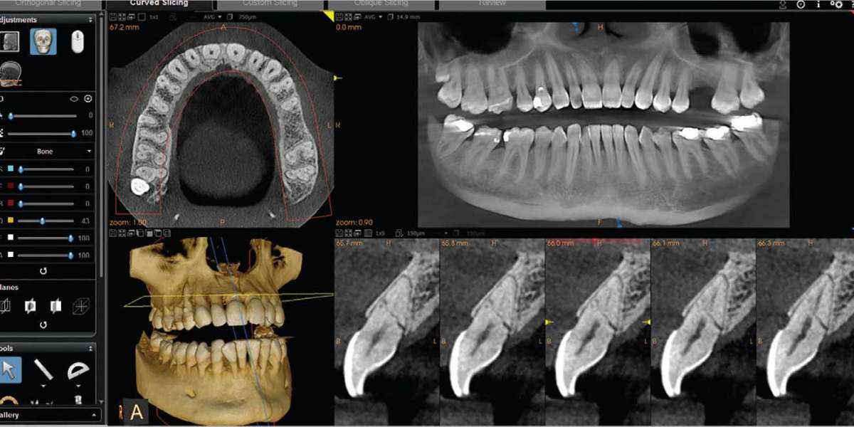 CBCT Dental Imaging Market Outlook on Industry CAGR Value over the Forecast Period