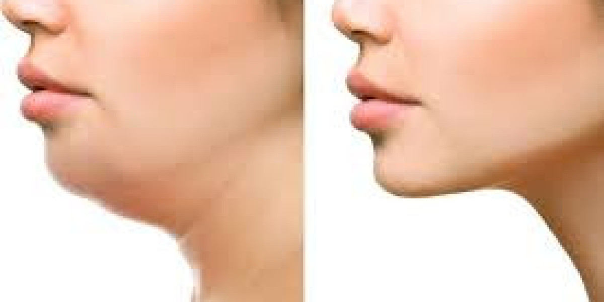 Liposuction for Double Chin in Dubai