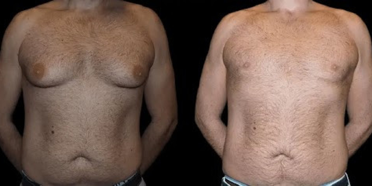 Male Breast Reduction Can Enhance Self-Esteem in Dubai