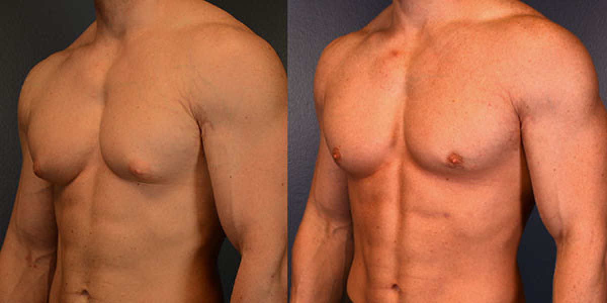 Gynecomastia Surgery and Chest Compression Shirts: Benefits for Recovery and Support