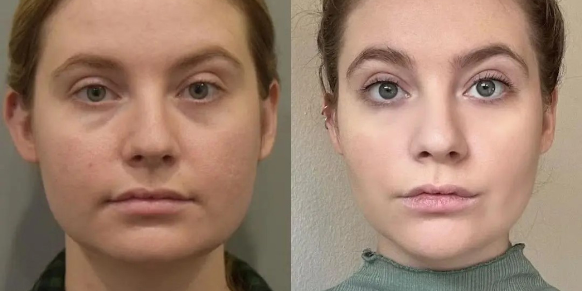 The Most Popular Buccal Fat Removal Techniques