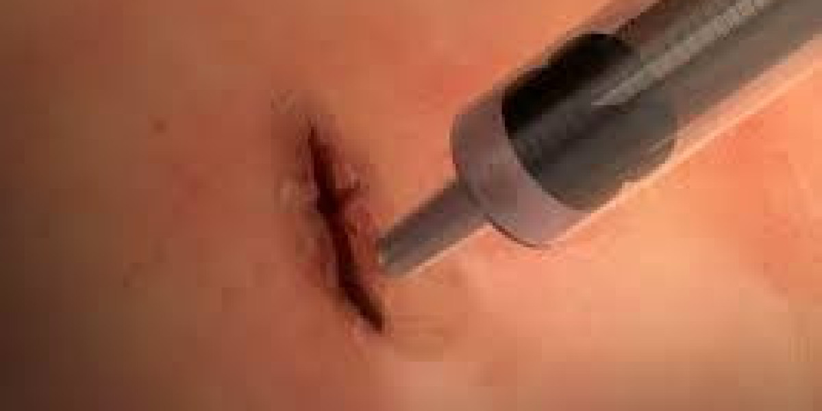 Surgical Glue Market Research Report: Global Industry Overview Report to 2032