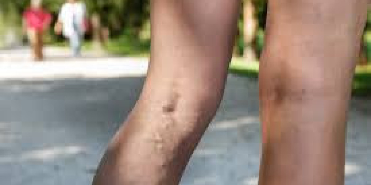 Exercise and Varicose Veins: Can Workouts Make Them Disappear?