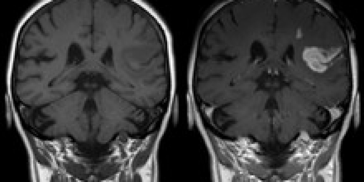 Global MRI Contrast Media Market: Trends, Innovations, and Future Growth Insights Forecast 2023 - 2033