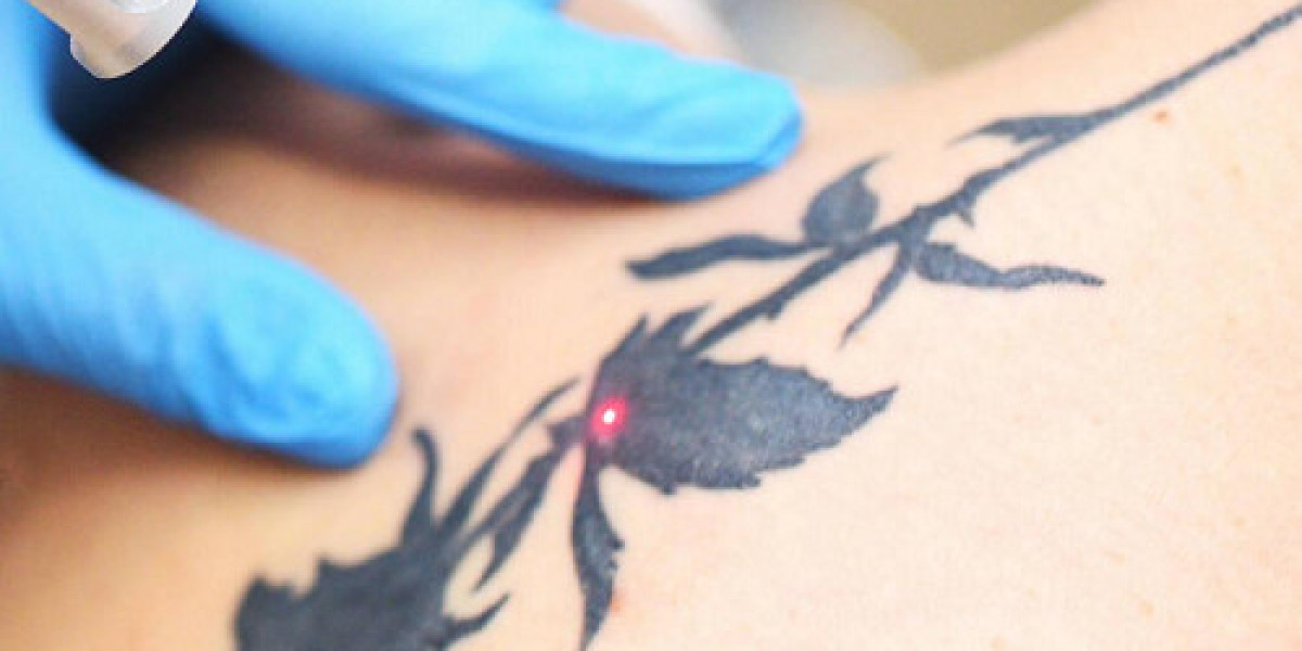 Top Reasons to Choose Laser Tattoo Removal in Dubai