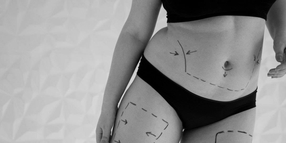 Achieve Your Dream Body with Non-Surgical Body Contouring in Hampshire