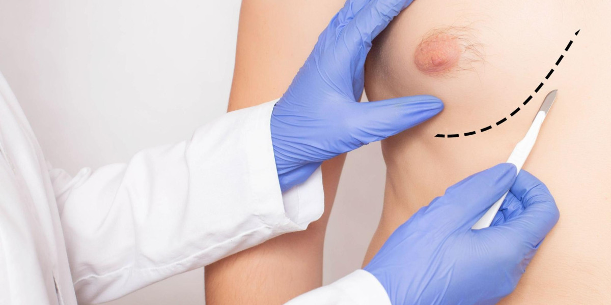 How to Identify True Gynecomastia vs. Pseudogynecomastia
