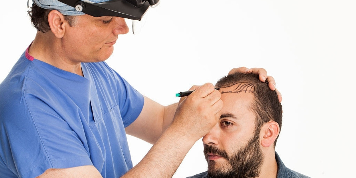 What to Expect Before, During, and After a Hair Transplant in Islamabad