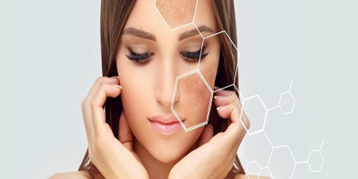 What are the most effective treatments for melasma?
