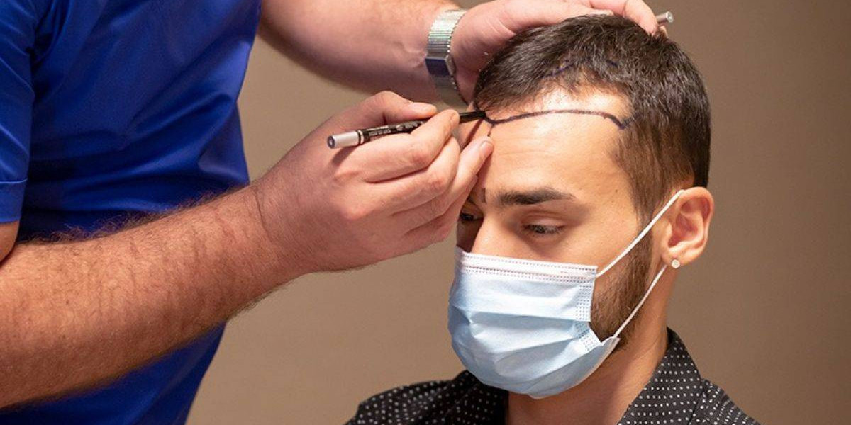 Is Hair Transplant Better than Hair Fibers and Concealers?