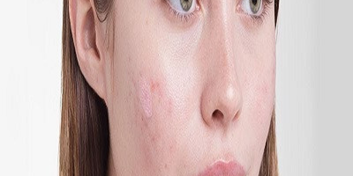 What is the success rate of acne scar removal treatments in Islamabad?