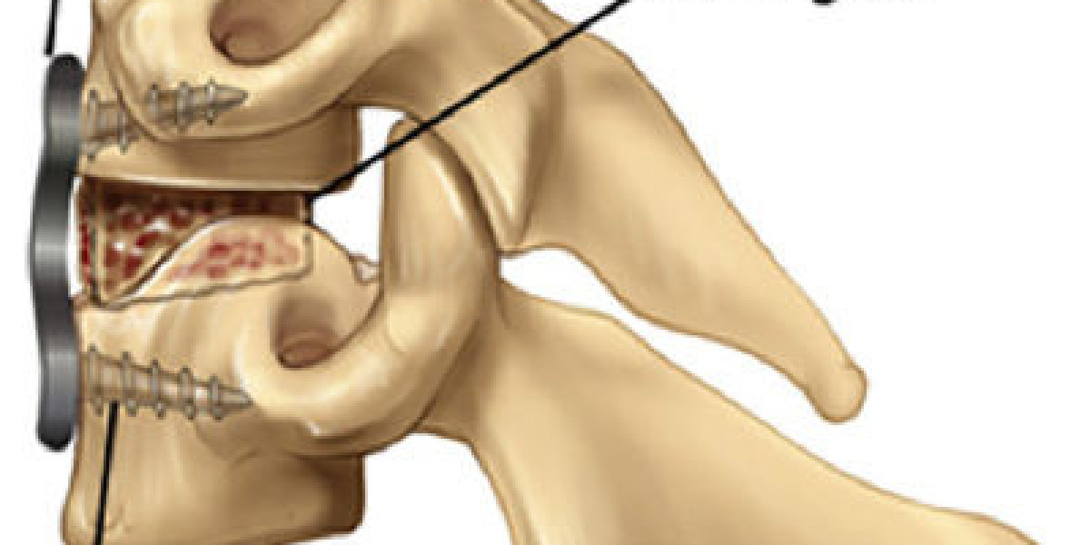 Anterior Cervical Fusion Surgery NJ