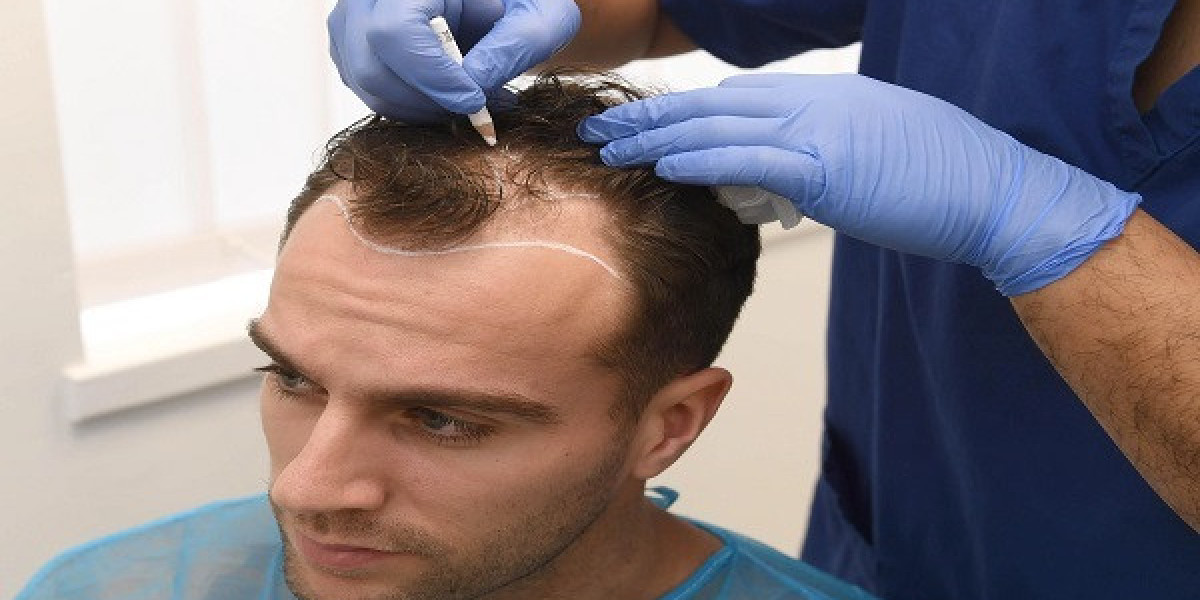 Hair Transplant Recovery Timeline in Islamabad