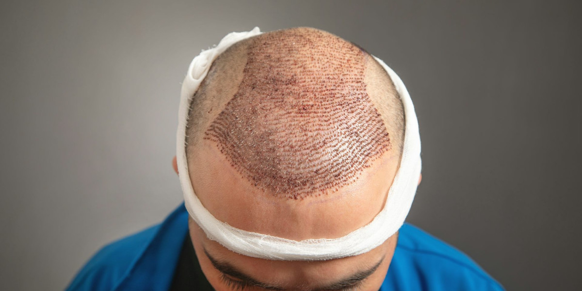 How do I book a consultation for a hair transplant in Islamabad?