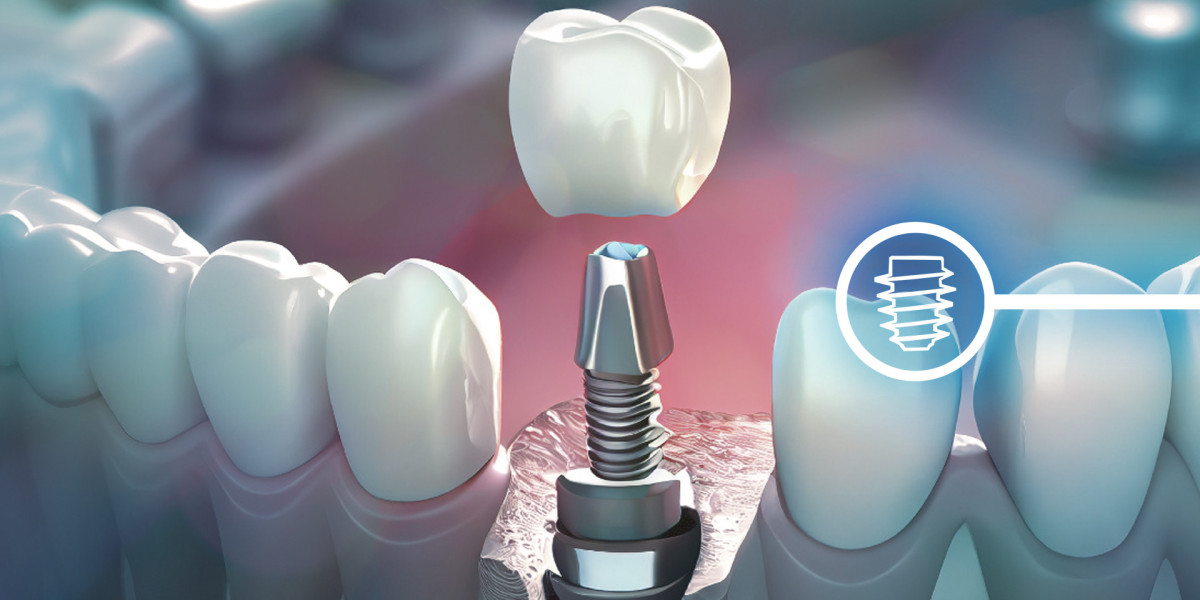 Understanding the Cost of Dental Implants in Islamabad