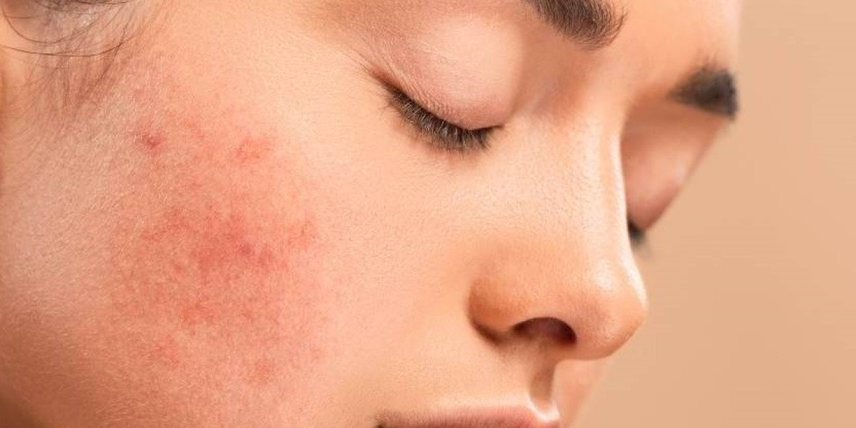 Permanent Solutions for Pigmentation Treatment in Islamabad
