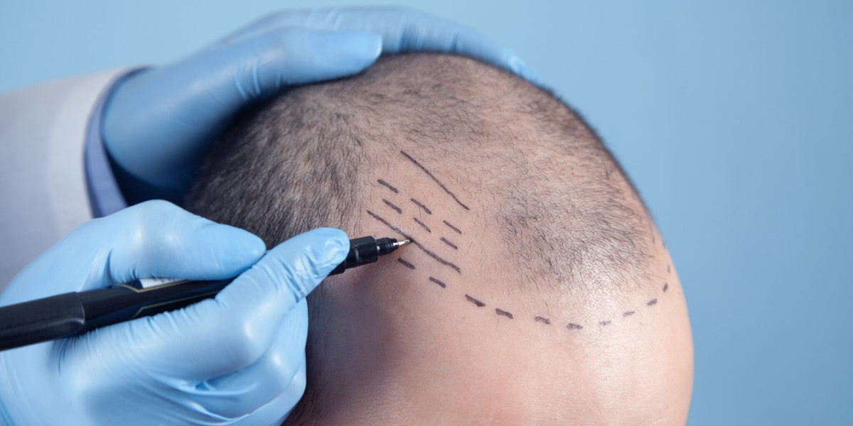 Can You Get Financing for Crown Hair Transplants in Islamabad?