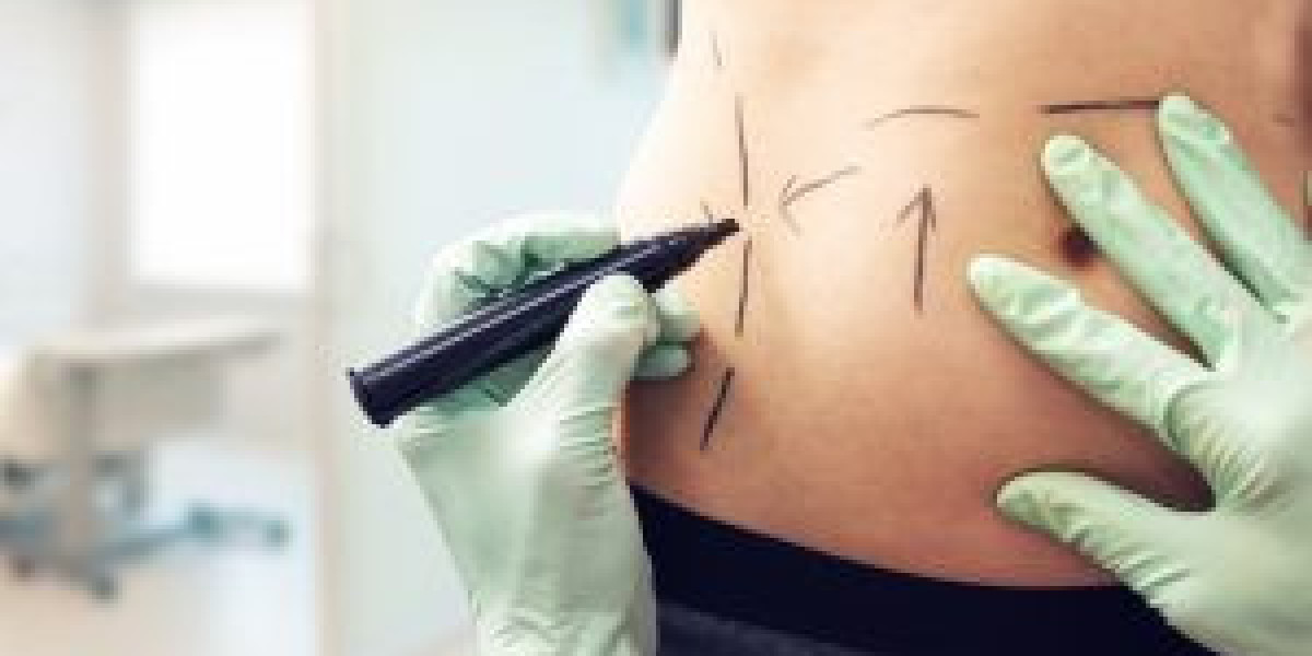 Tummy Tuck Dubai Offers: Affordable Luxury with Premium Results
