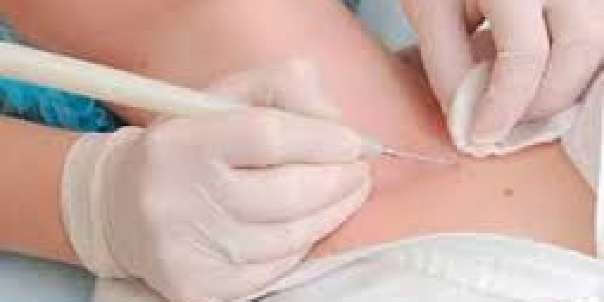 Видалення новоутворень шкіри: безпечний шлях до здорової та чистої шкіри